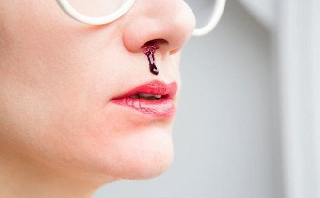 Chảy máu cam là một trong các triệu chứng của u ác khoang mũi